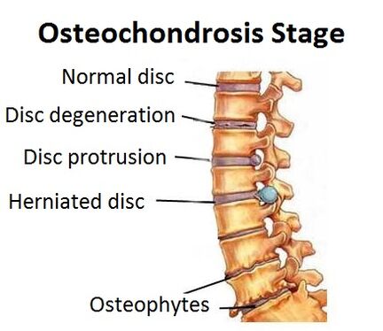 Étapes d'ostéochondrose