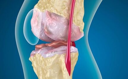 Les raisons du développement de l'arthrose de l'articulation du genou